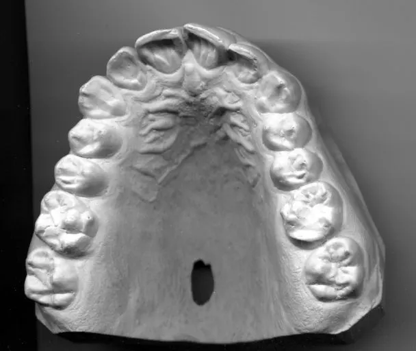 Denture