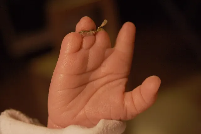 Congenital amputation