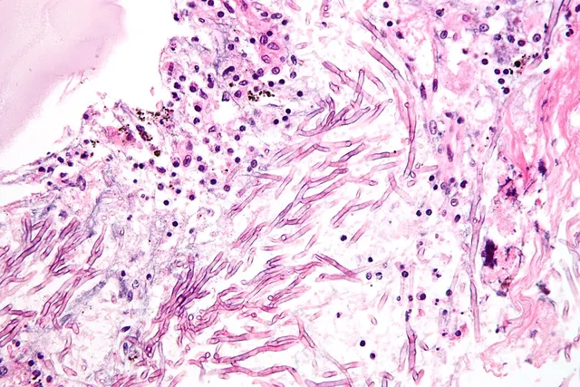 Fungal infection