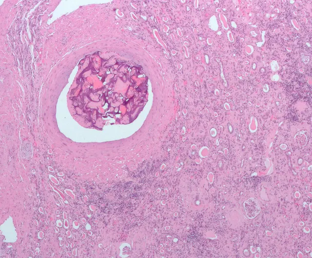 Embolism