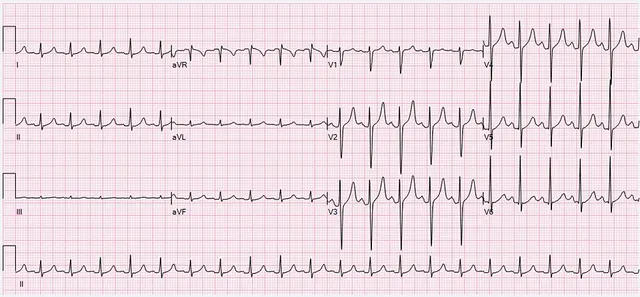 Sinus tachycardia