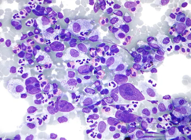 Hodgkin lymphoma