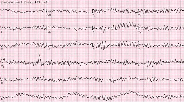 Arrhythmia
