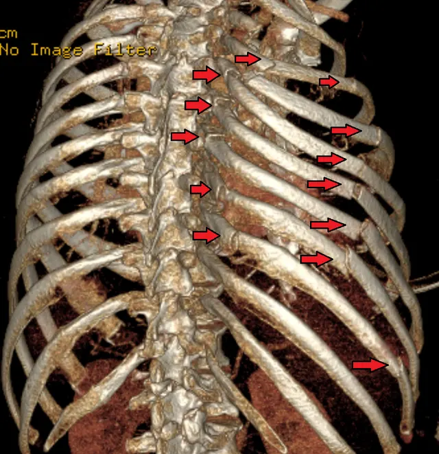 Flail chest