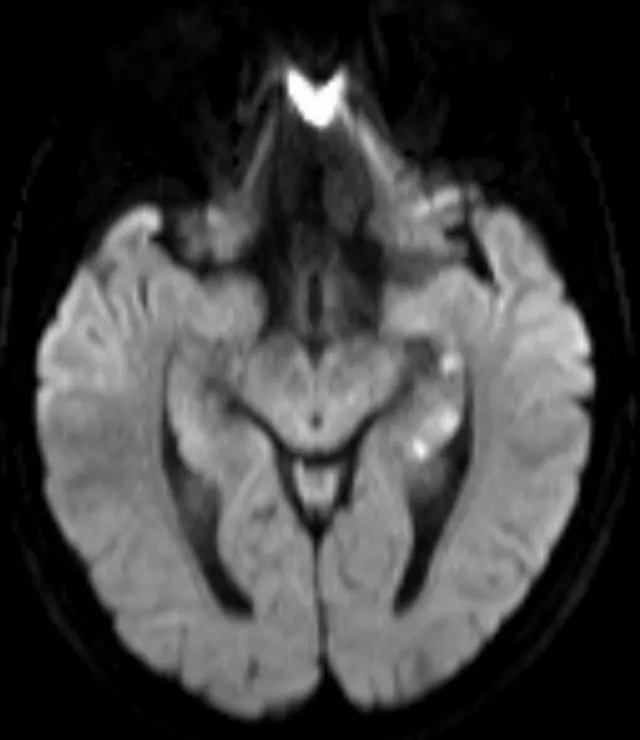 Transient global amnesia