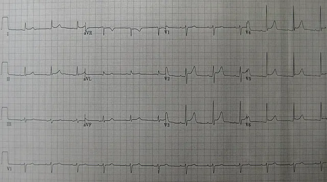 Acute pericarditis