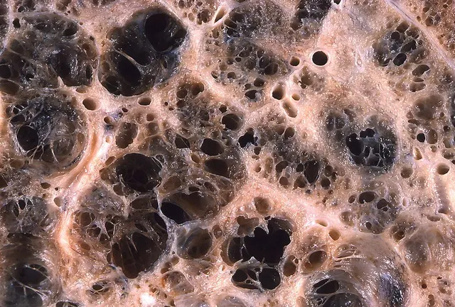 Emphysème pulmonaire