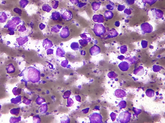 Lymphome B