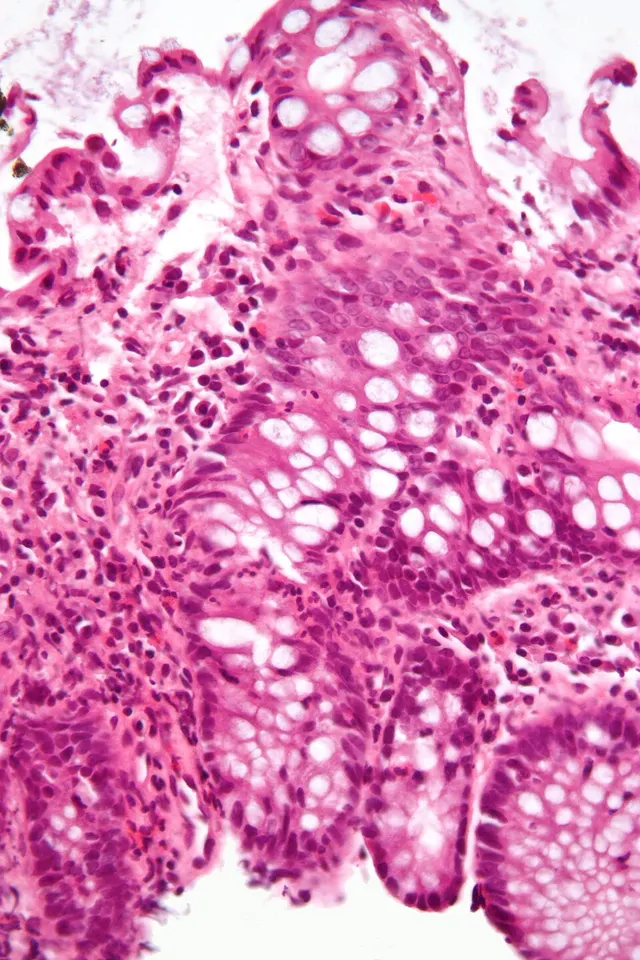 Inflammatory bowel disease