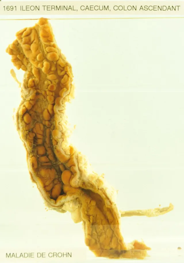 Crohn's disease