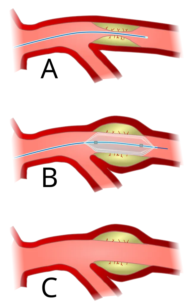 Angioplasty