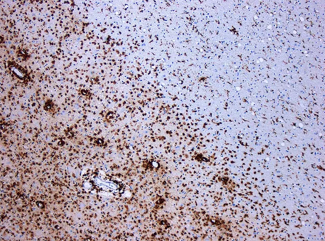 Demyelinating disease